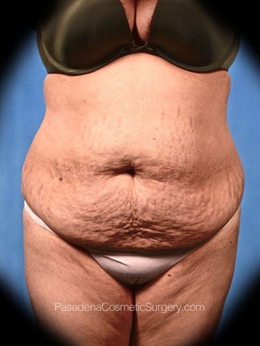Tummy Tuck Patient 22 Before