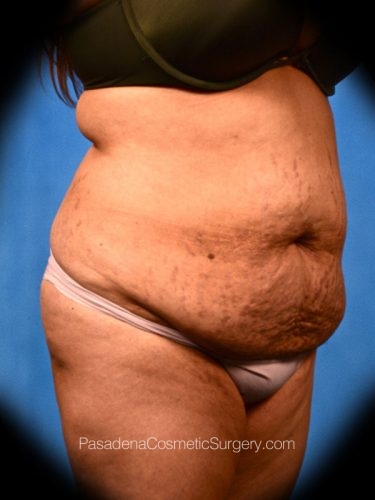 Tummy Tuck Patient 22 Before - 2