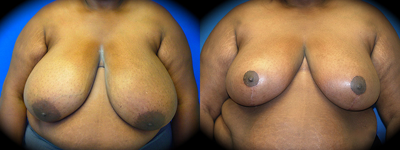 Breast Reduction in Pasadena, CA Before & After Patient 2