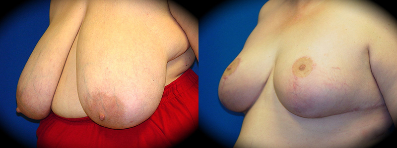 Breast Reduction in Pasadena, CA Before & After Patient 1