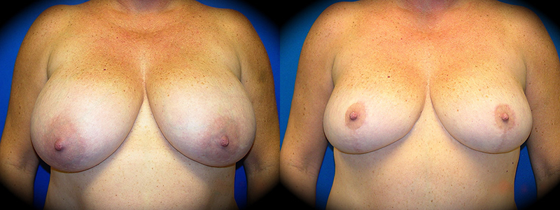 Breast Reduction in Pasadena, CA Before & After Patient 3