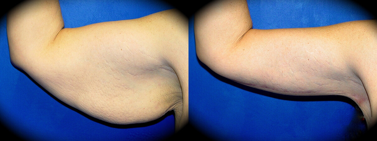 Arm Lift in Pasadena, CA Before & After Patient 1