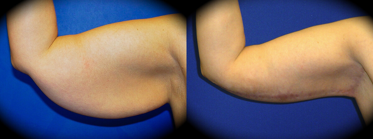 Arm Lift in Pasadena, CA Before & After Patient 2