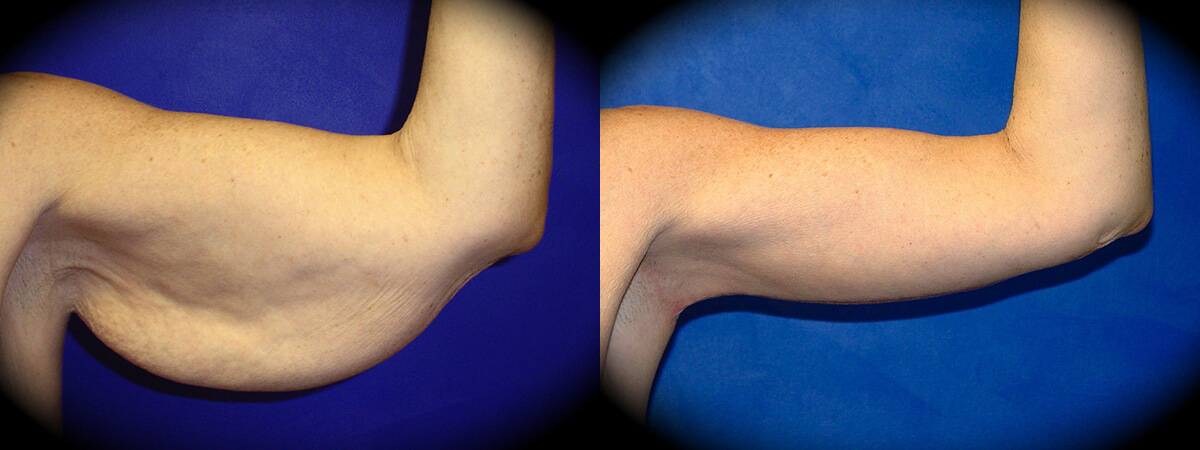 Arm Lift in Pasadena, CA Before & After Patient 3