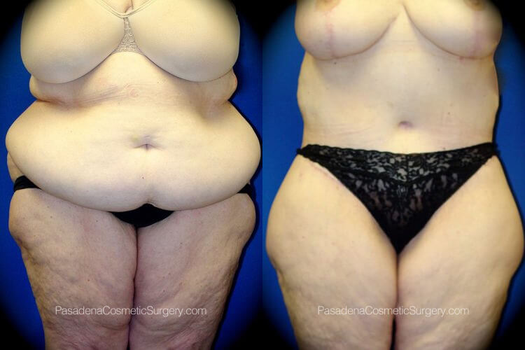 Body Lift in Pasadena, CA Before & After Patient 1