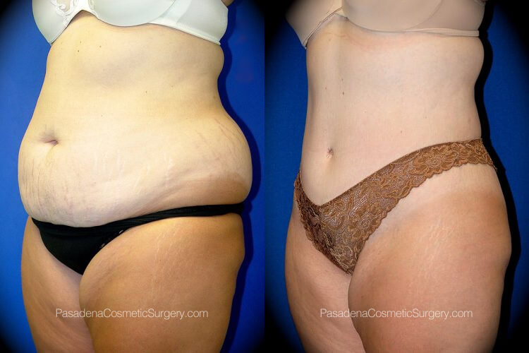 Body Lift Before & After Patient 2