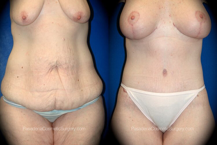 Body Lift Before & After Patient 3