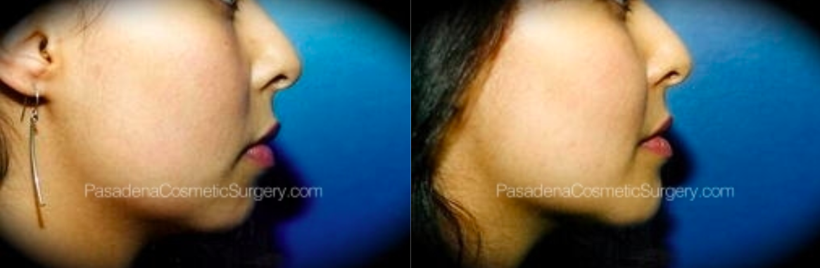 Chin augmentation patient before and after