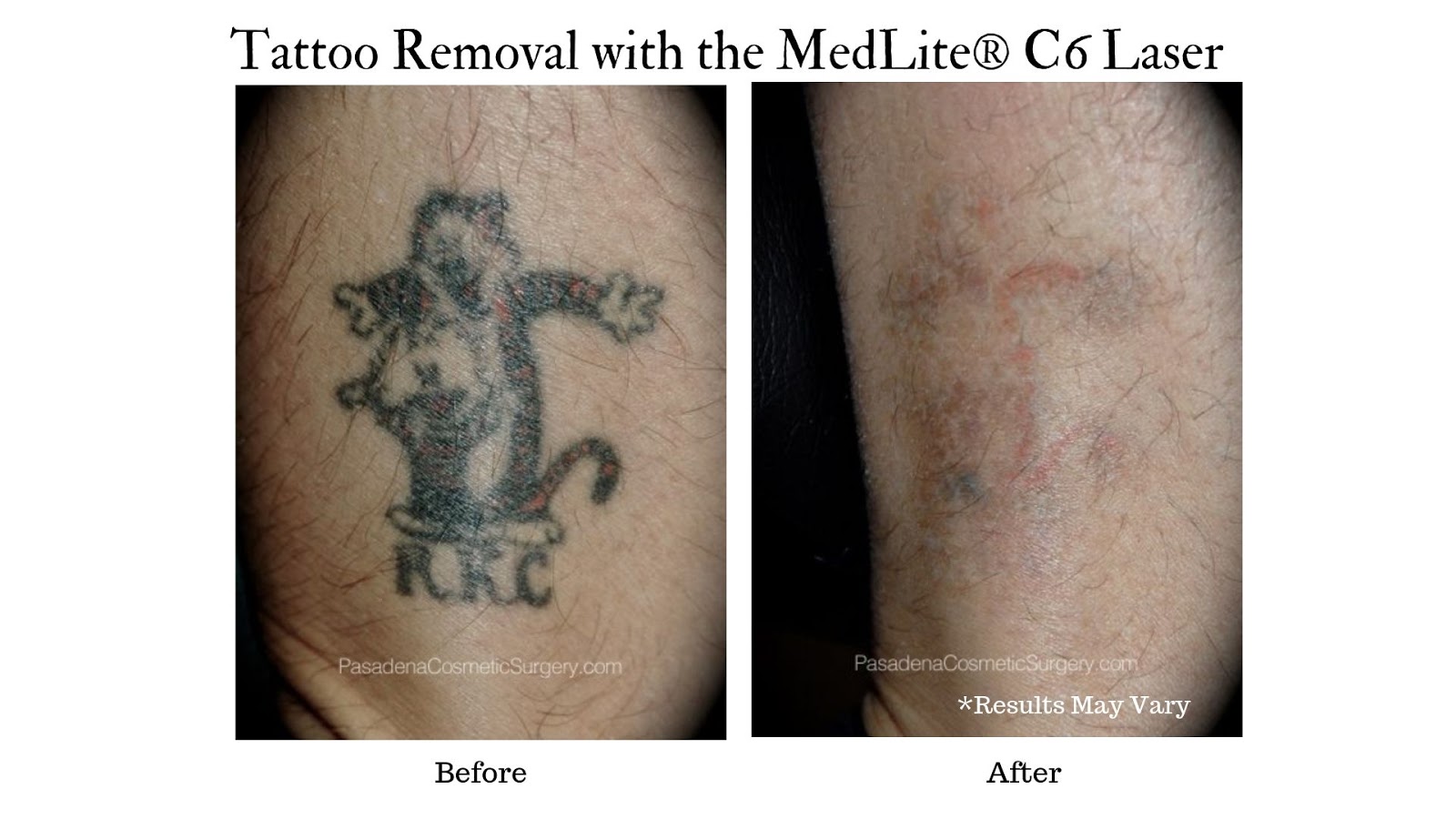 Ozmedica Aesthetic Clinic  Four wavelengths fewer treatments Precise and  gentle the medical grade Medlite C6 laser is the most effective laser for tattoo  removal breaking up unwanted tattoos into tiny ink