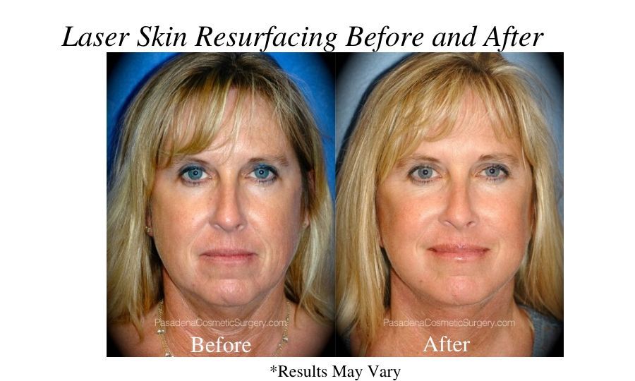 Before and after image showing the results of a laser skin resurfacing patient in Pasadena, CA.