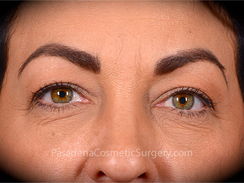 Eyelid Surgery Patient 29 After