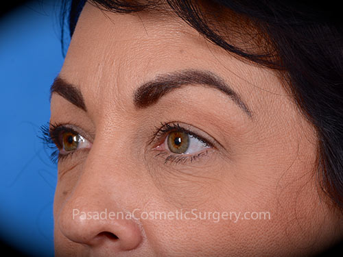 Eyelid Surgery Patient 29 After - 2