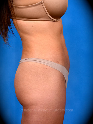 Liposuction Patient 06 After - 3