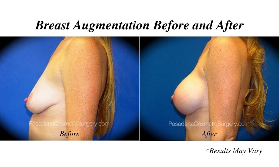 before-and-after-breast-augmentation-2016_09_96127_a3