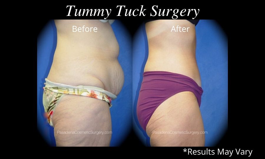 Tummy Tuck Surgery – Pasadena Surgeons