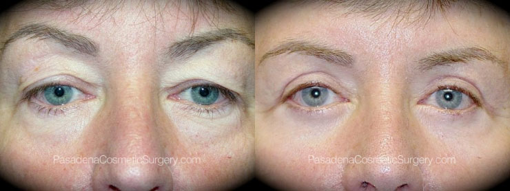 Eyelid Surgery in Pasadena Before & After Patient 1