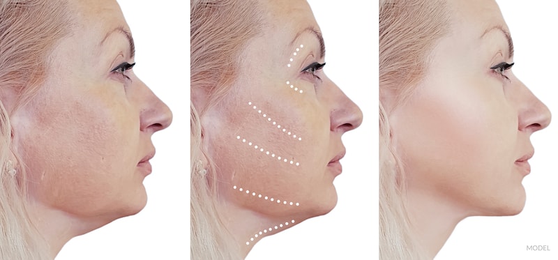 Before and after image showing a facelift.