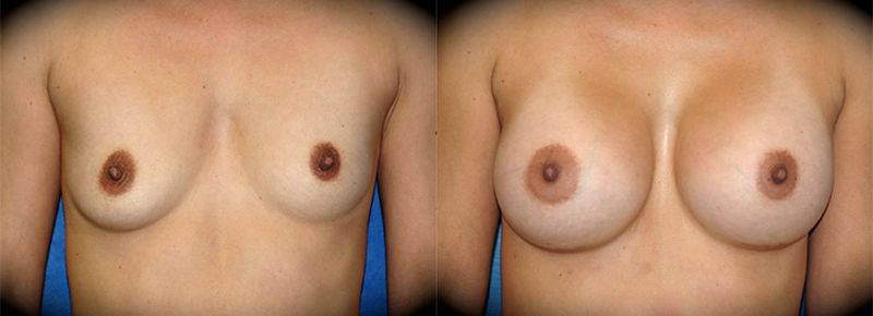 Breast Augmentation in Pasadena, CA Before & After Patient 3