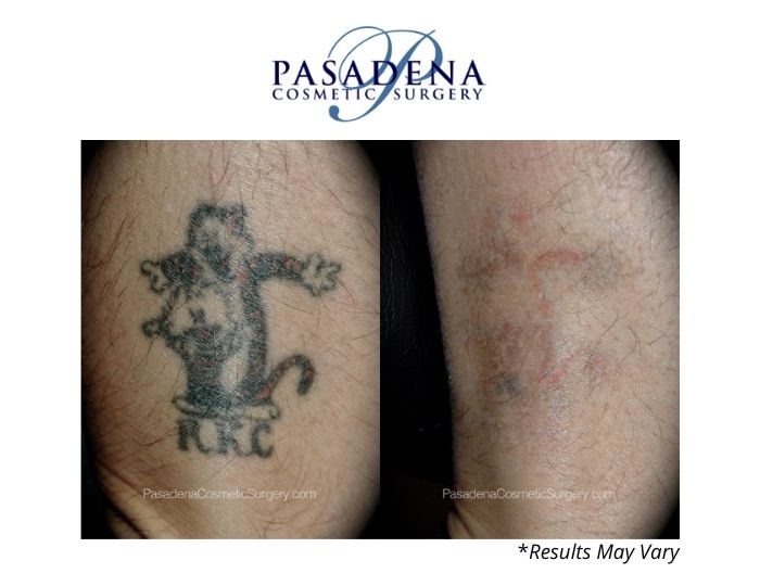 Before and after image showing the results of a laser tattoo removal performed in Pasadena, CA.