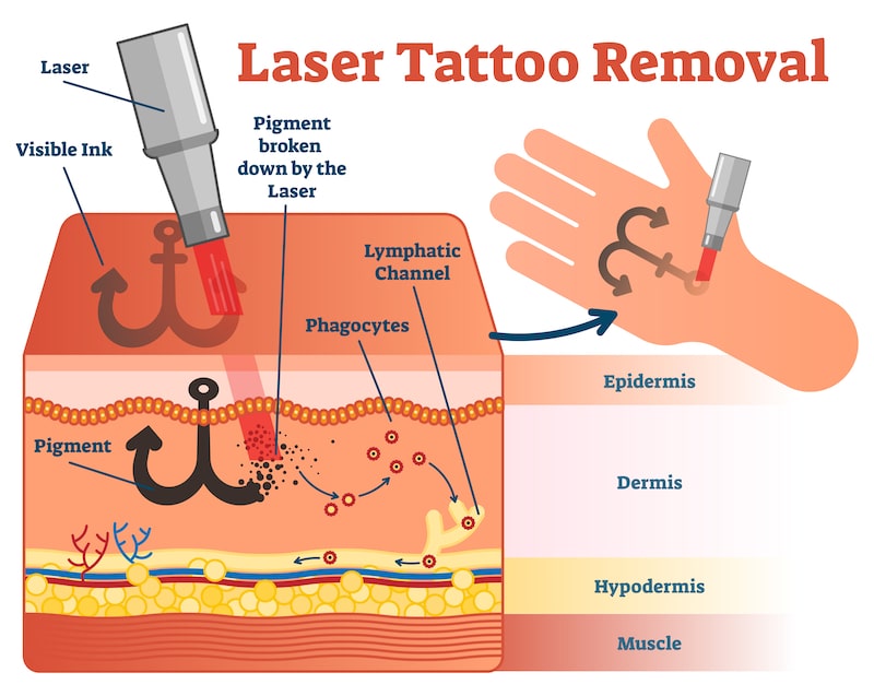 Illustration showing laser tattoo removal process