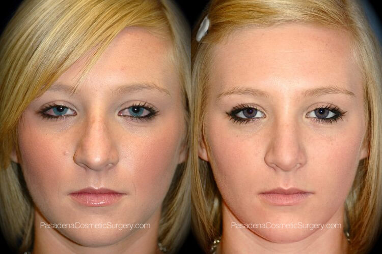 Rhinoplasty in Pasadena, CA Before & After Patient 2