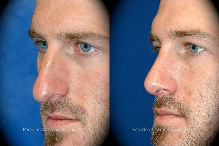 Rhinoplasty in Pasadena Before & After Patient 3