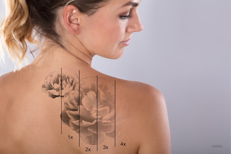 Woman's back with different stages of laser tattoo removal.