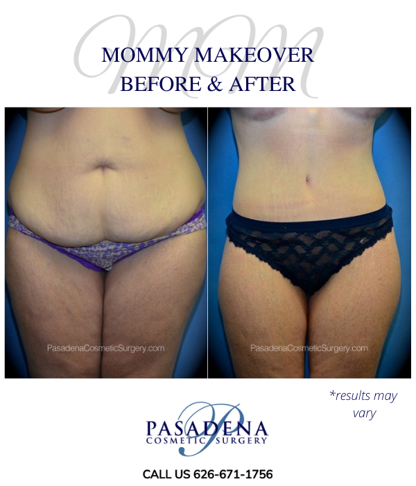 Before and after image showing the results of a Mommy Makeover performed in Pasadena, CA.