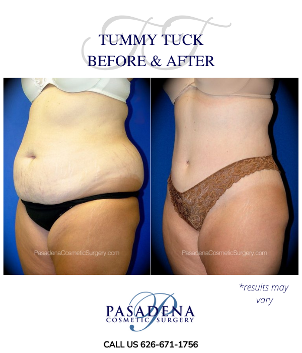 Before and after image showing the results of a tummy tuck performed in Pasadena, CA.