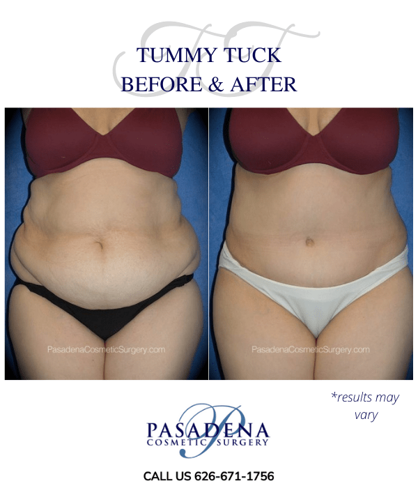 Before and after image showing the results of a tummy tuck performed in Pasadena, CA.