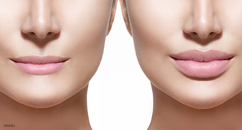 Before and after photo of a lip augmentation procedure.