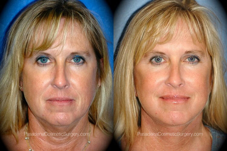 Non-Surgical Procedures Before & After Patient 2