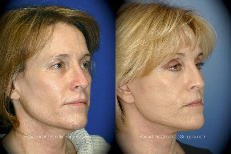 Non-Surgical Procedures in Pasadena, CA Before & After Patient 3