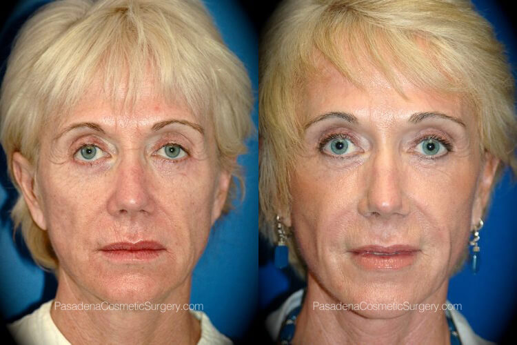 Non-Surgical Procedures in Pasadena, CA Before & After Patient 1