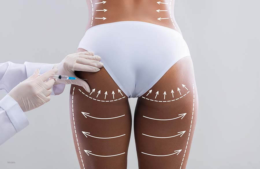 A doctor injects fat into the left buttocks of a woman.