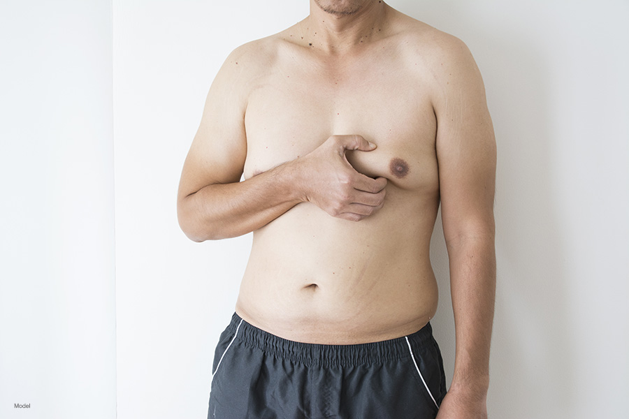 A man with gynecomastia squeezes his enlarged breast.