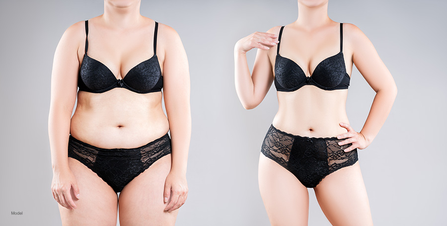 A before and after photo of tummy tuck surgery features a woman wearing a black bra and underwear.