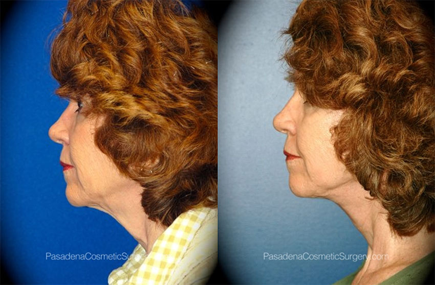 woman before and after neck lift