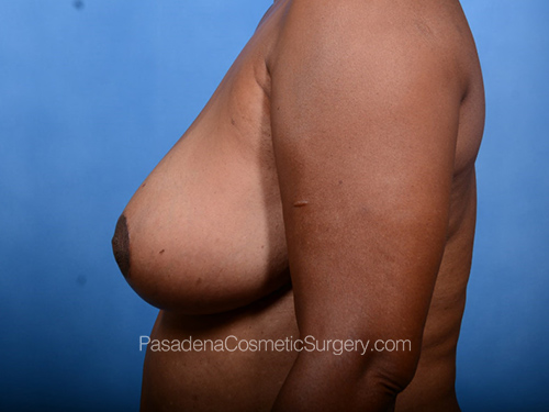 Breast Reduction Patient 05 After - 5