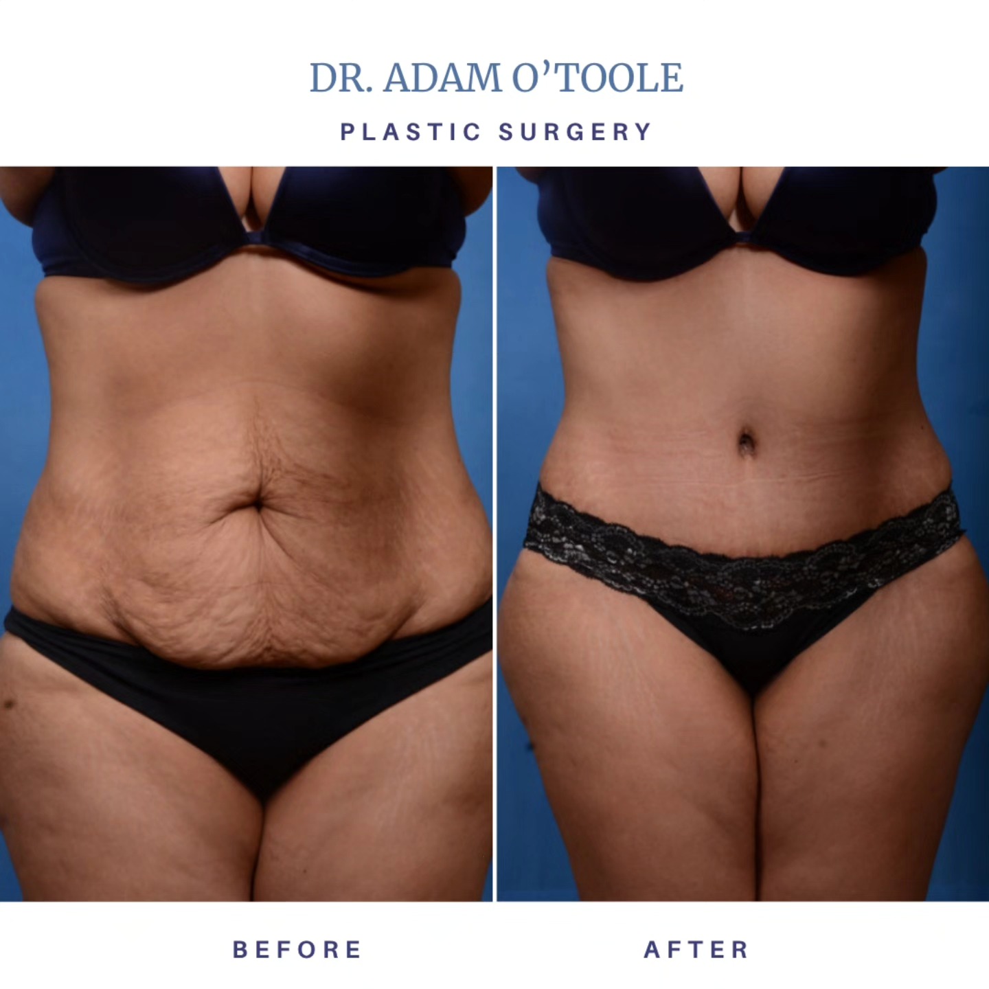 Real results. Real confidence. Swipe to see how liposuction and removiing excess skin and can make a big impact. Book a consultation to learn more about how we can help you achieve your goals. #beforeandafter #cosmeticsurgery #DrOToole #tummytuck #tummytuckrecovery