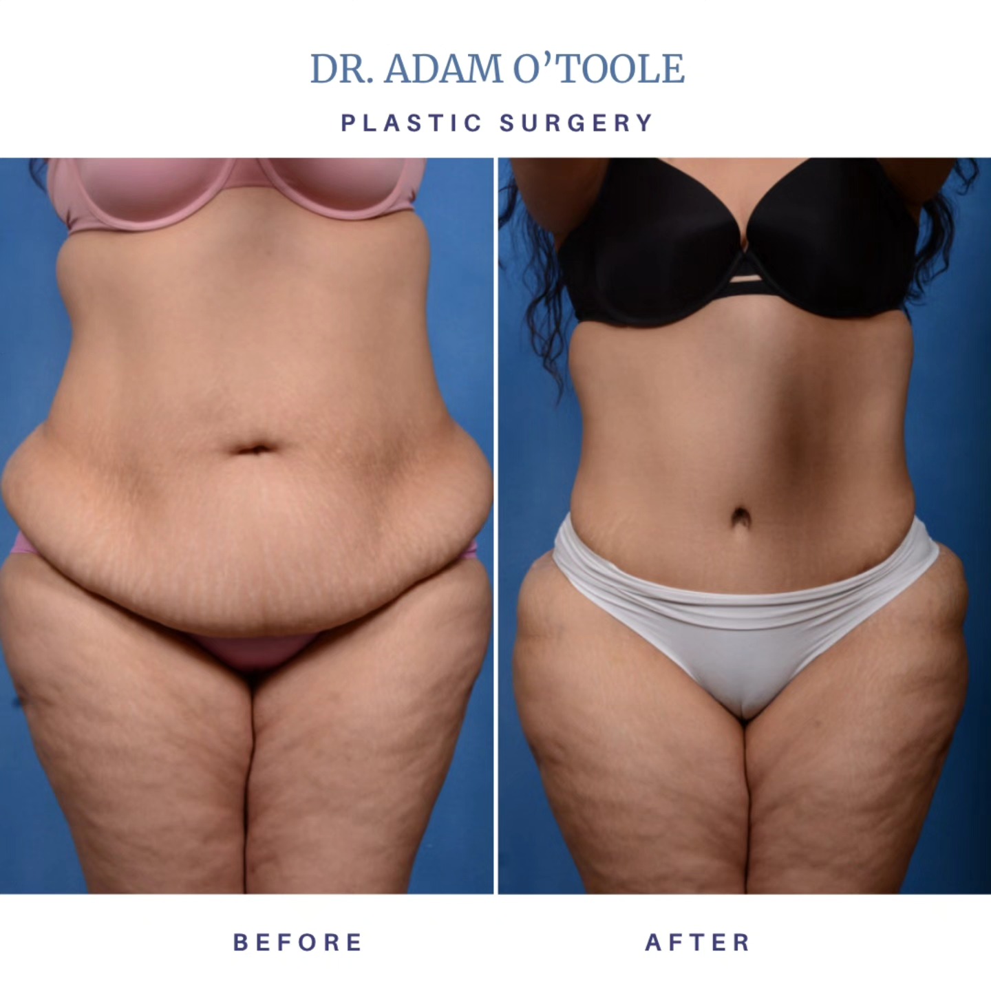 Transformation Spotlight This patient took a brave step toward reclaiming her confidence with a tummy tuck by Dr. Adam O'Toole. After addressing loose skin and abdominal separation, she now feels stronger, more confident, and truly aligned with the woman she sees in the mirror. When you invest in yourself, the results go far beyond the surface. Performed by Dr. Adam O'Toole – known for precision, artistry, and patient-centered care. #TummyTuckTransformation #Abdominoplasty #BeforeAndAfter #DrAdamOToole #PlasticSurgeryJourney #ConfidenceBoost #InvestInYourself #LookGoodFeelGood #PostBabyBody #CoreConfidence #SelfLoveJourney #AestheticSurgery #PatientTransformation