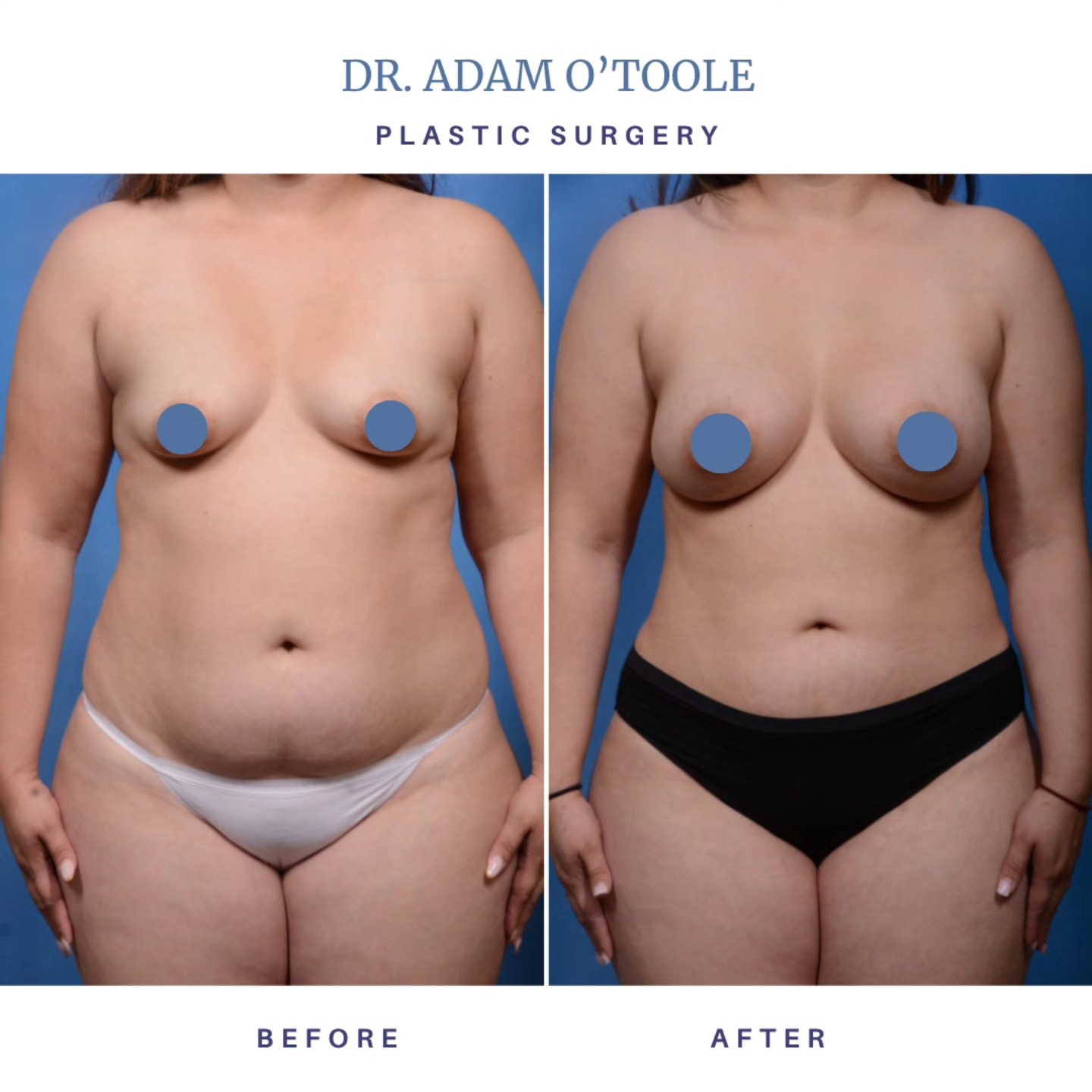 A sculpted, confident transformation! This beautiful patient combined breast augmentation with liposuction to achieve a more balanced, contoured, and feminine silhouette. Breast implants can restore or enhance volume, while liposuction refines curves and highlights your natural shape — a powerful combination for a truly stunning result. Swipe to see her amazing transformation! Call us at 626-449-8910 to schedule your consultation and start your own journey. #BeforeAndAfter #BreastAugmentation #Liposuction #BodyContour #SculptedSilhouette #ConfidenceBoost #PatientTransformation #FeelConfident #EmpoweredWomen #BodyGoals #DrAdamOToole #PasadenaPlasticSurgery #PlasticSurgery #SelfCare