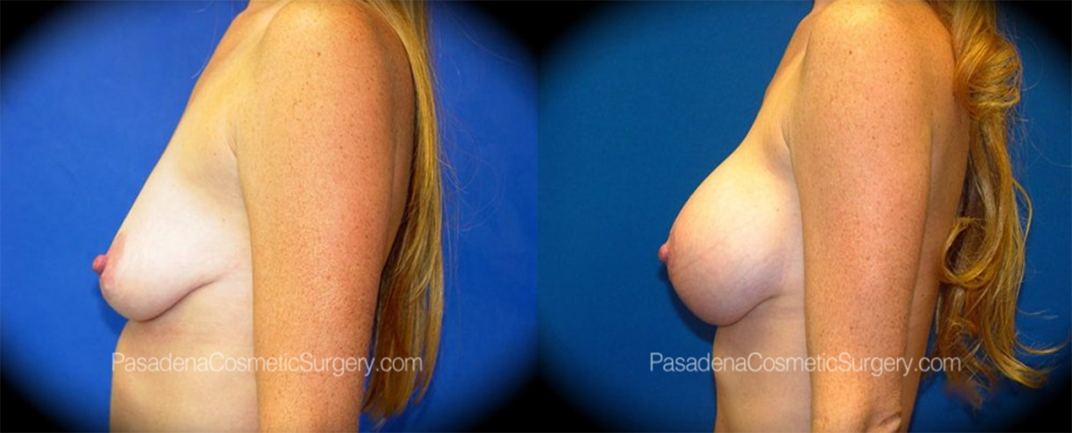 Breast Implant Revision in Pasadena, CA Before & After Patient 1
