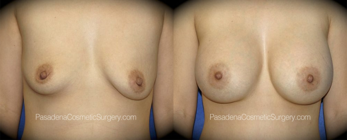 Breast Implant Revision in Pasadena, CA Before & After Patient 2