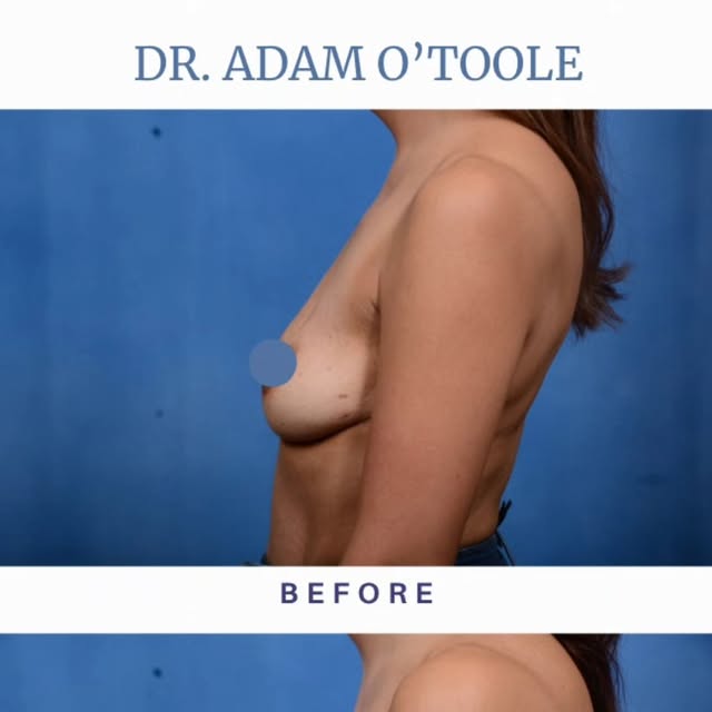 This patient chose to invest in herself with a breast augmentation by Dr. Adam O'Toole. Today, she radiates confidence—because embracing your beauty isn’t just about how you look, it’s about how you feel. #ConfidenceBoost #SelfLoveJourney #BreastAugmentation #CosmeticSurgery #PlasticSurgeryJourney #BeforeAndAfter #BeautyEnhancement #DrAdamOToole #TopSurgeon #AestheticMedicine #SurgicalArtistry #PatientTransformation #LookGoodFeelGood #InnerBeautyOuterGlow #InvestInYourself #BeYourBestSelf