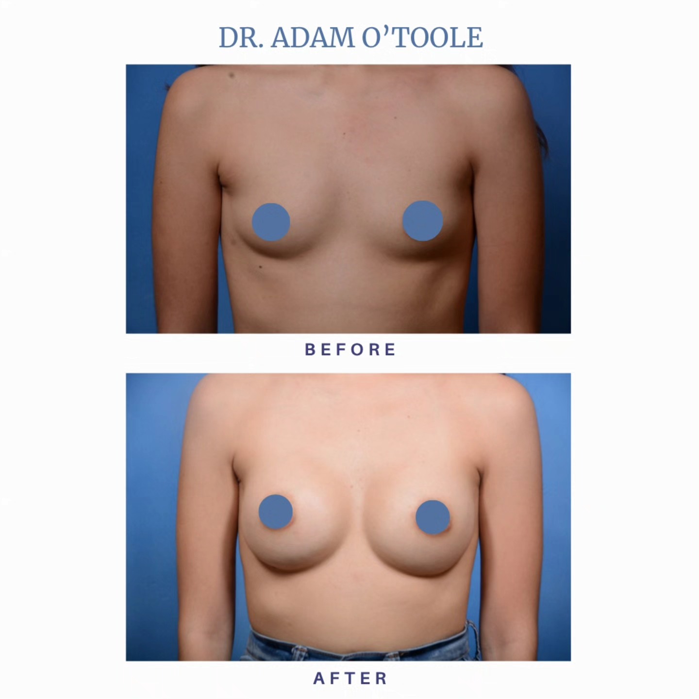 Our patient wanted a fuller, more balanced look while maintaining a natural silhouette and the results speak for themselves! Customized implant size Natural contour enhancement Confidence boosted Thinking about taking the next step? Schedule your consultation today. Pasadena (626) 449-8910 #BreastAugmentation #BeforeAndAfter #PlasticSurgery #NaturalResults #ConfidenceBoost #DrAdamOToole